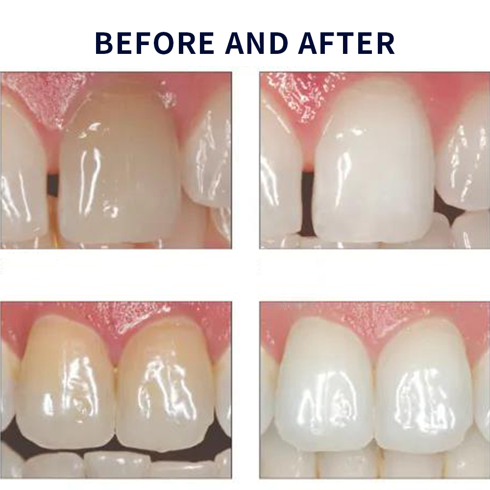 Opalescence Whitening 20% PF 2 - Teeth Whitening Home Kit review and price