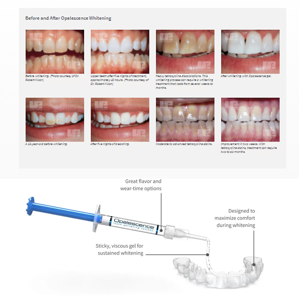 Opalescence Whitening 20% PF 2 - Teeth Whitening Home Kit review and price