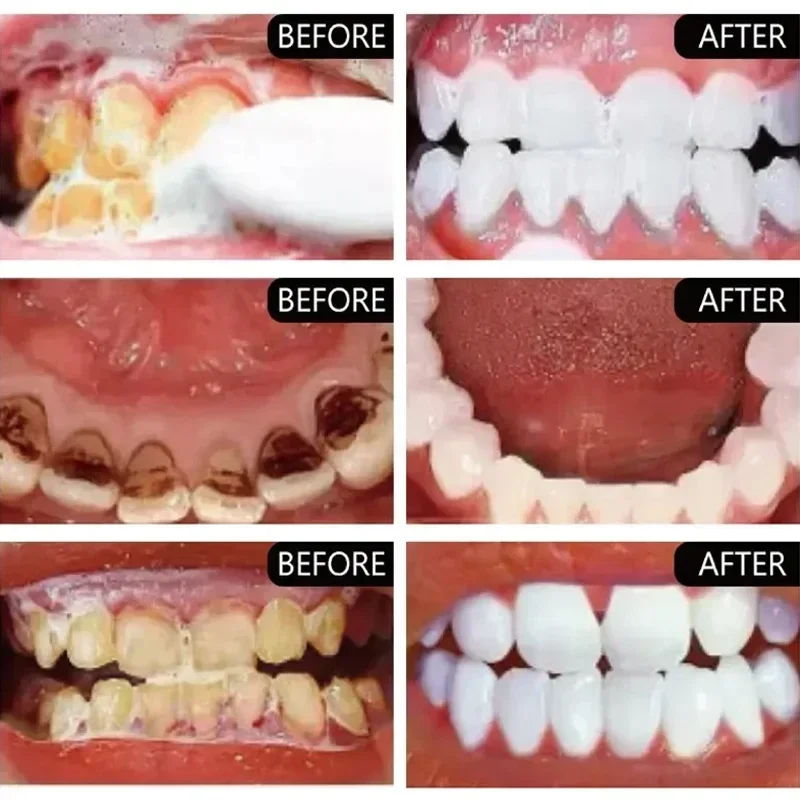 Fast Remove Smoke Stains Tooth - Teeth Whitening Fast review and price