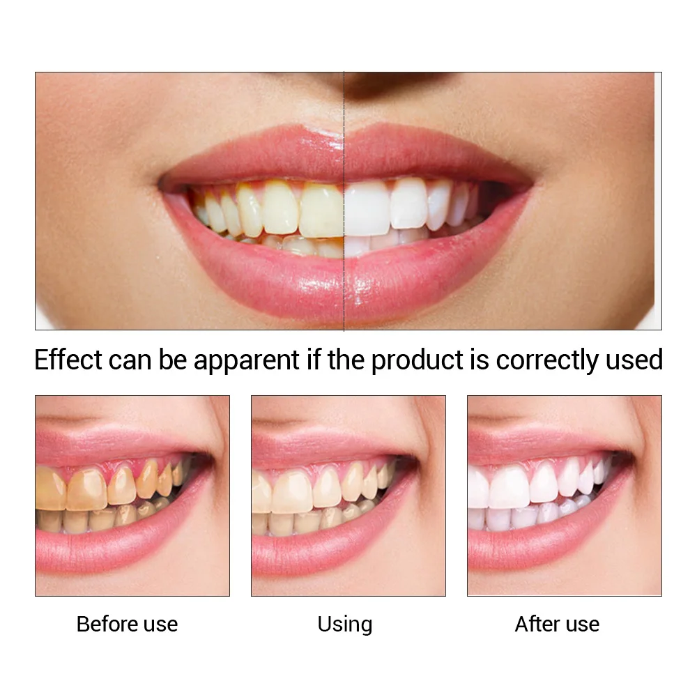 FTEENPLY Teeth Whitening Essen - Teeth Whitening Price review and price