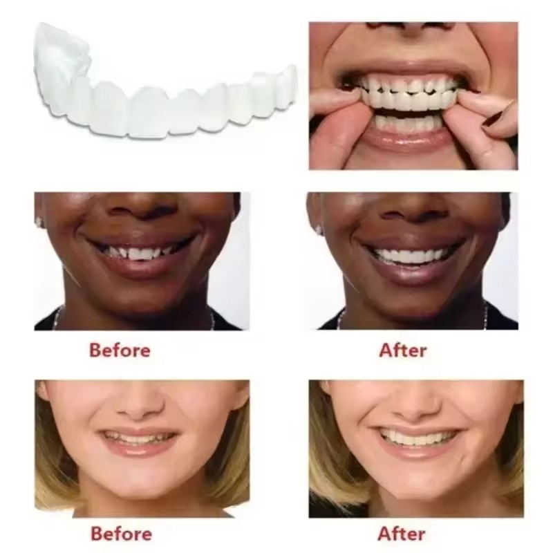 Teeth Veneers Whitening Dentur - Teeth Whitening With Braces review and price
