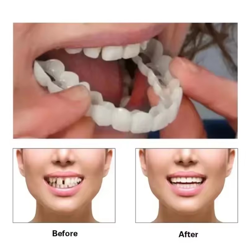 Teeth Veneers Whitening Dentur - Teeth Whitening With Braces review and price
