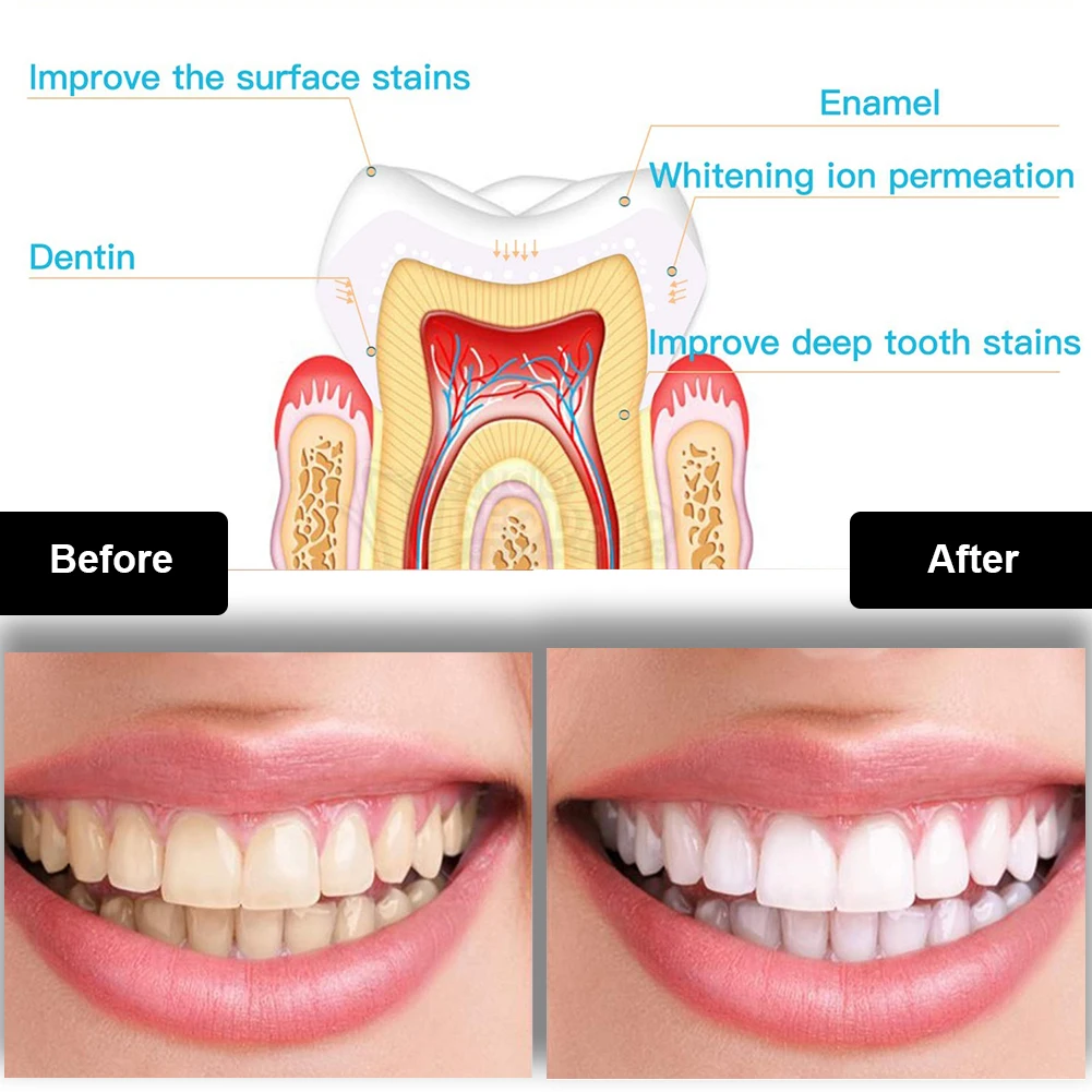 Dental Teeth Whitening Kit Min - Teeth Whitening Price review and price