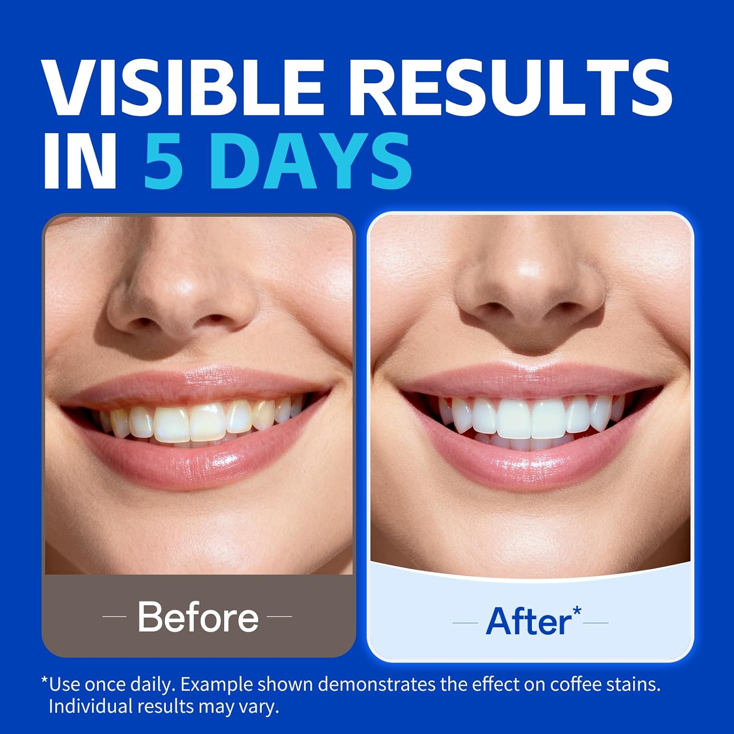KHAZIX Teeth Whitening Strips  - Teeth Whitening Oil Pulling review and price